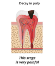2. Tooth abscesses or cysts