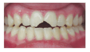 3. Teeth injuries