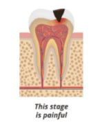 1. Untreated Carries