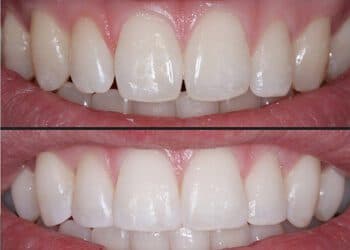 Composite Bonding