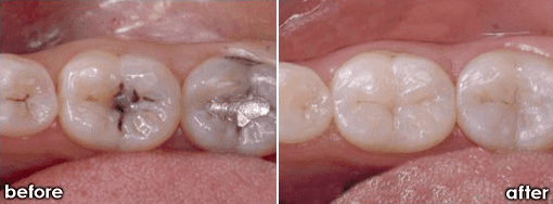 Fillings
