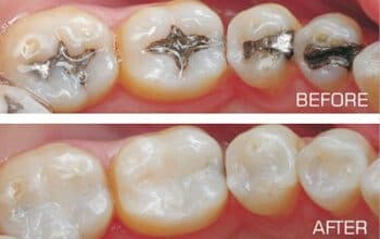 Tooth Coloured Fillings