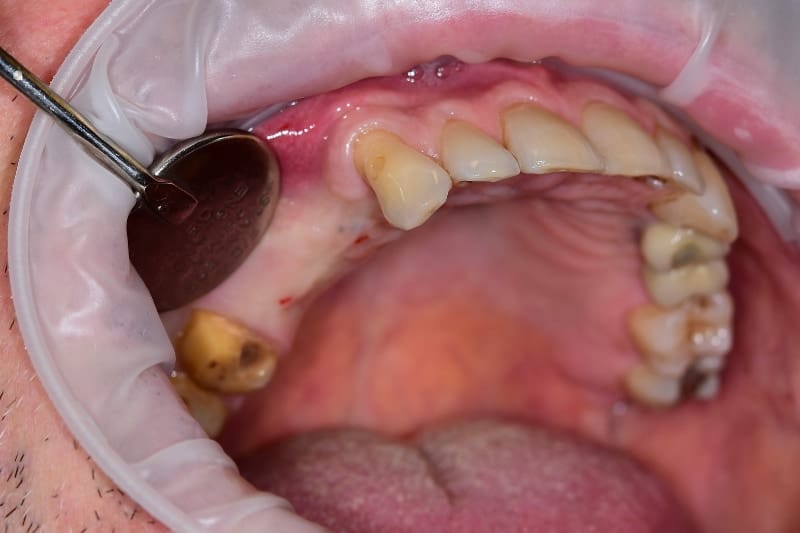 Bridge on implants — initial presentation