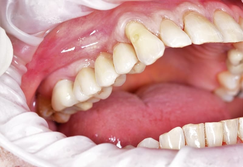 Bridge on implants — final result
