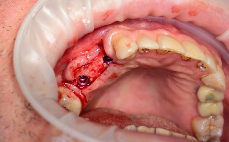 Bridge on implants — implants placed