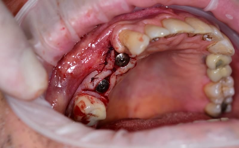 Bridge on implants — bridge fitted