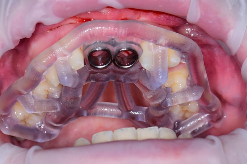 Guided implant case — pre-treatment