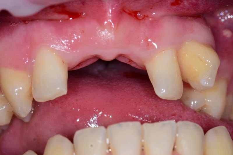Guided implant case — post-treatment review