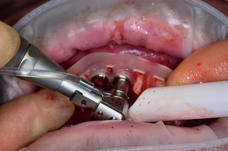 Guided implant case — digital planning