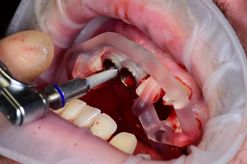 Guided implant case — surgical guide