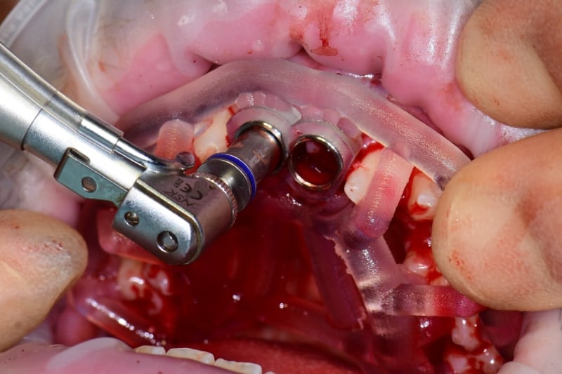 Guided implant case — implant placement