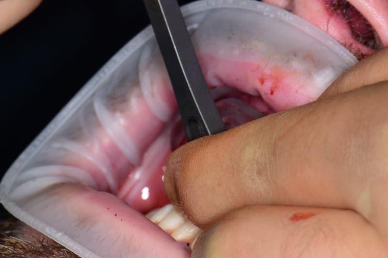 Guided implant case — healing
