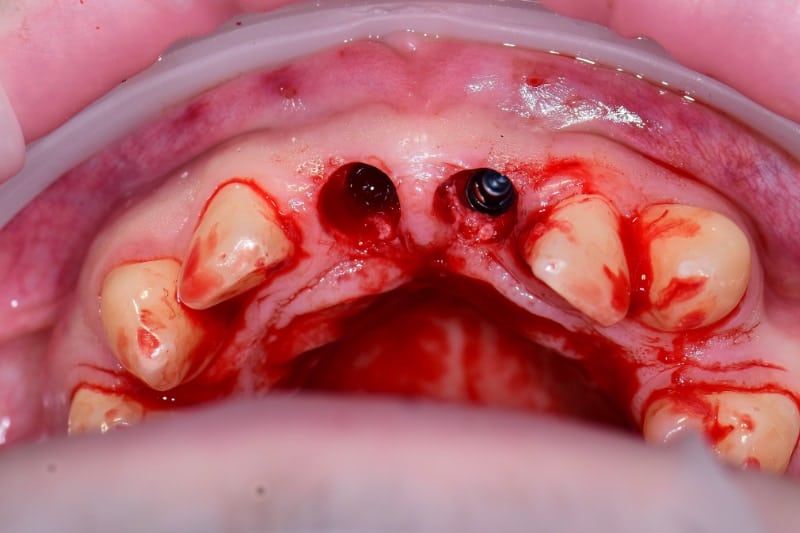 Guided implant case — abutment fitted