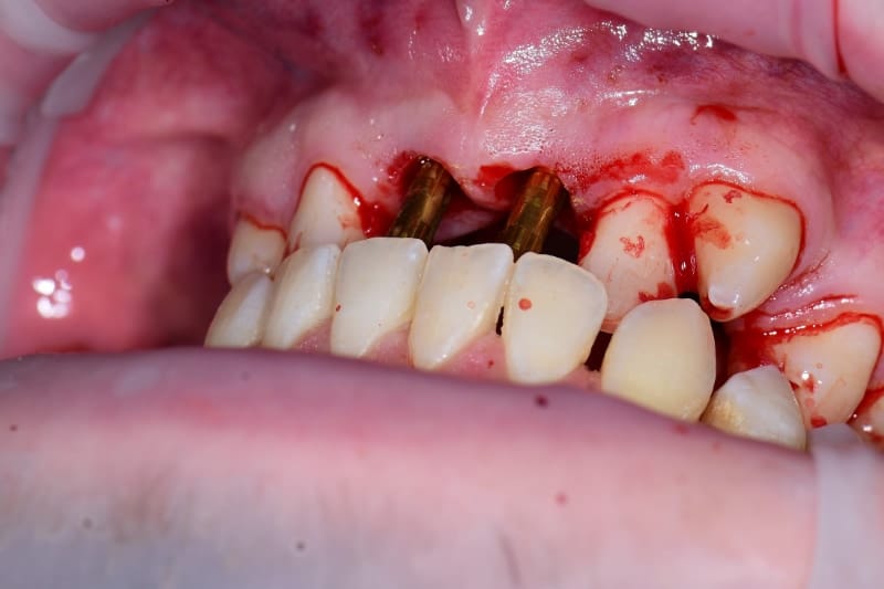 Guided implant case — crown try-in