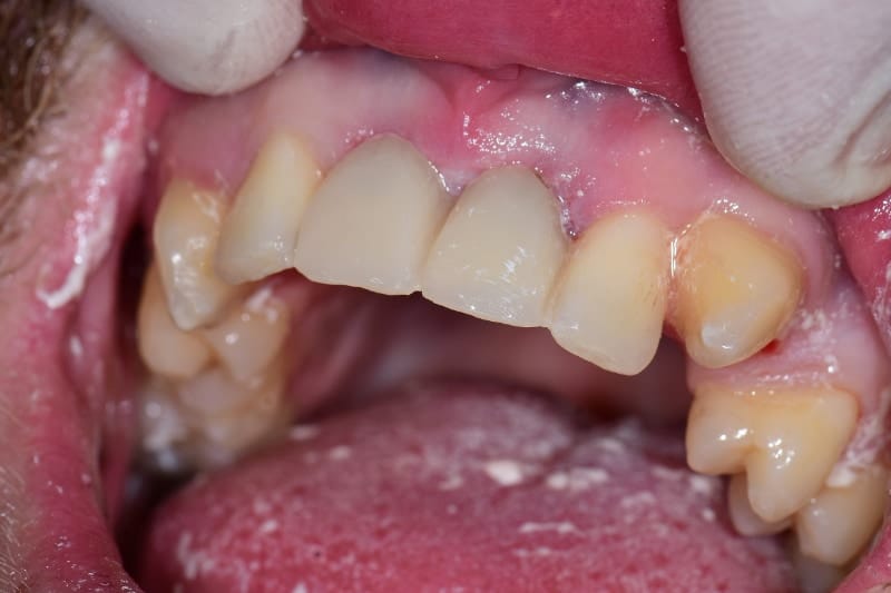 Guided implant case — finished crown