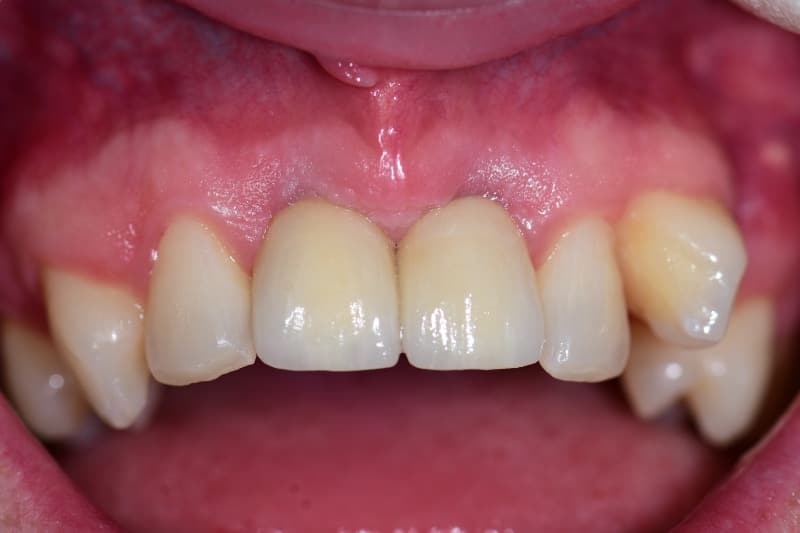 Guided implant case — final smile