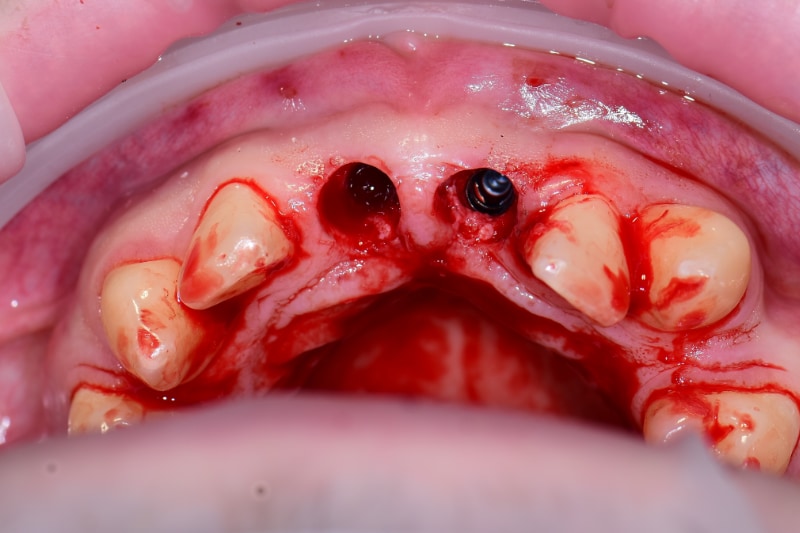 Guided Implant Case - Image 7