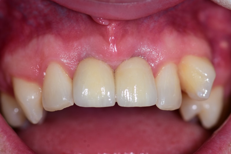 Guided Implant Case - Image 10